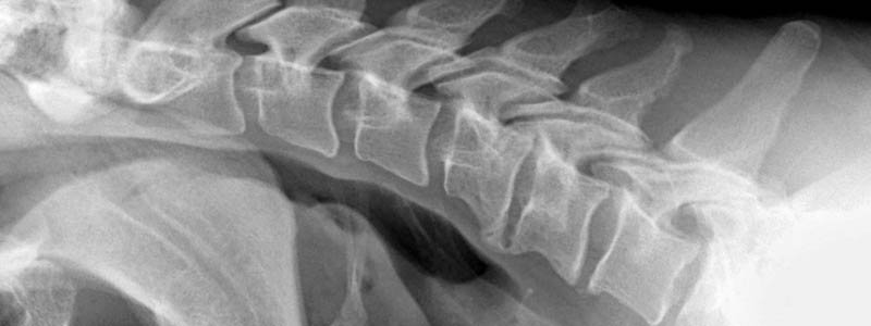 neck-xray